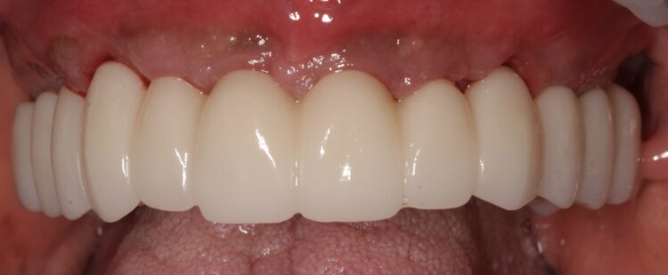 Figure 23a: Final restoration in situ