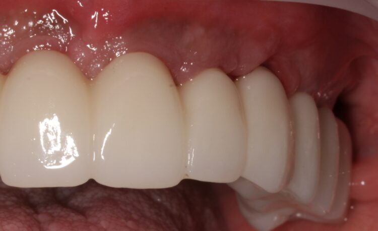 Figure 23b: Final restoration side views