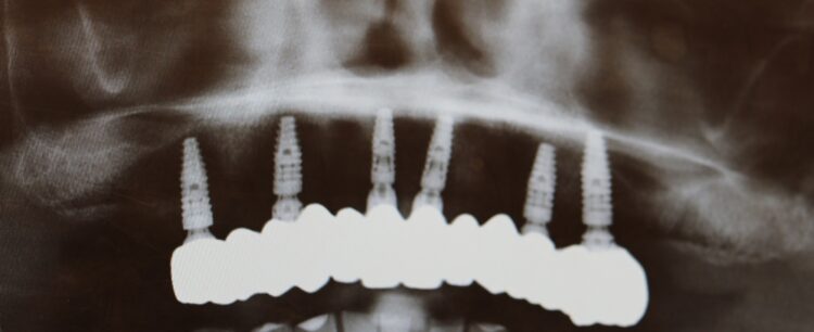 Figure 24: Final prosthesis OPG