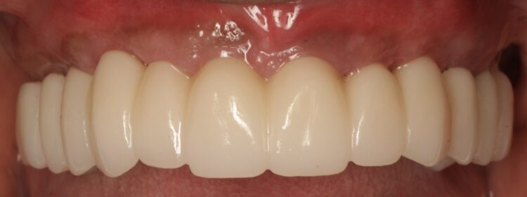 Figure 25: Final prosthesis one year follow-up