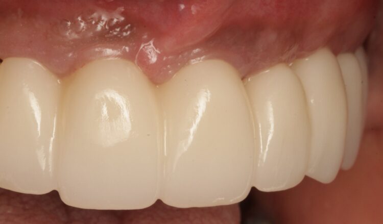 Figure 25b: Final restoration side views one year follow-up