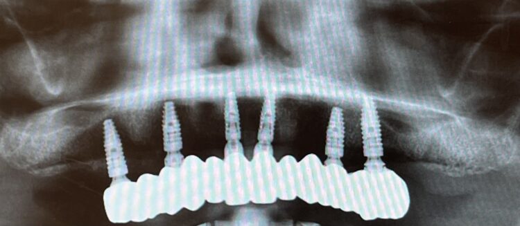 Figure 26: OPG one year follow-up