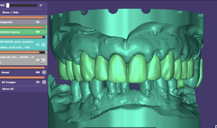 Figure 4c: Exocad digital smile design