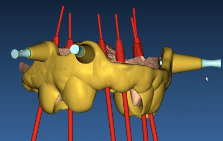 Figure 5: Teeth and bone supported surgical guide planning for accurate implant placement