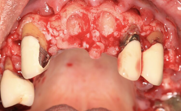 Figure 8: Remaining teeth to support surgical guide