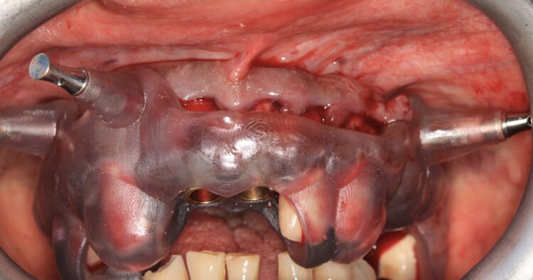 Figure 9: Teeth supported surgical guide secured with anchor pins