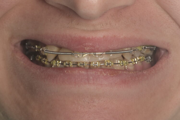 Figure 1: Mid-orthodontic correction