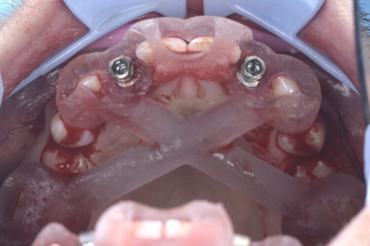 Figure 11: Implant installed through guide