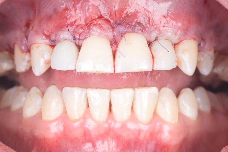 Figure 12: Soft tissue grafting and tension free closure