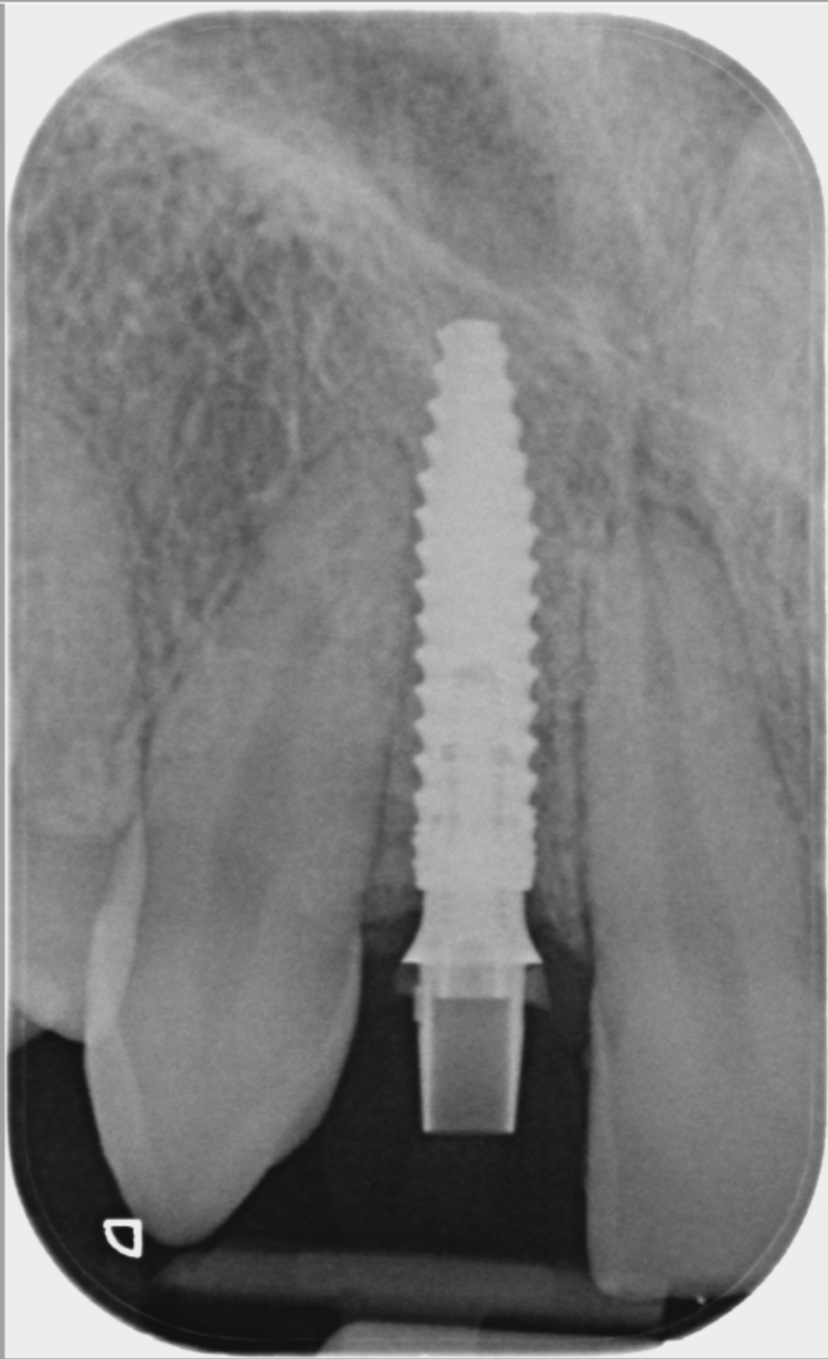 Figure 13: UR2 1 week post-operative x-ray