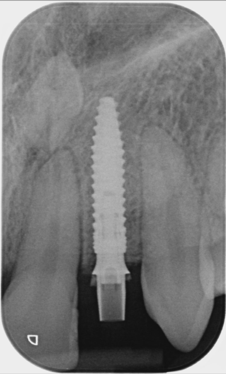 Figure 14: UL2 1 week post-operative x-ray