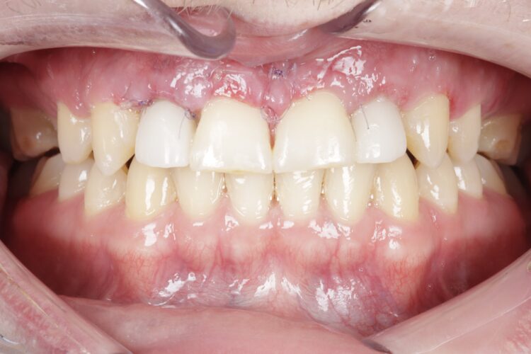 Figure 15: 1 week post-operative review