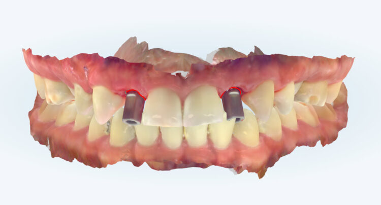 Figure 17: iTero scan