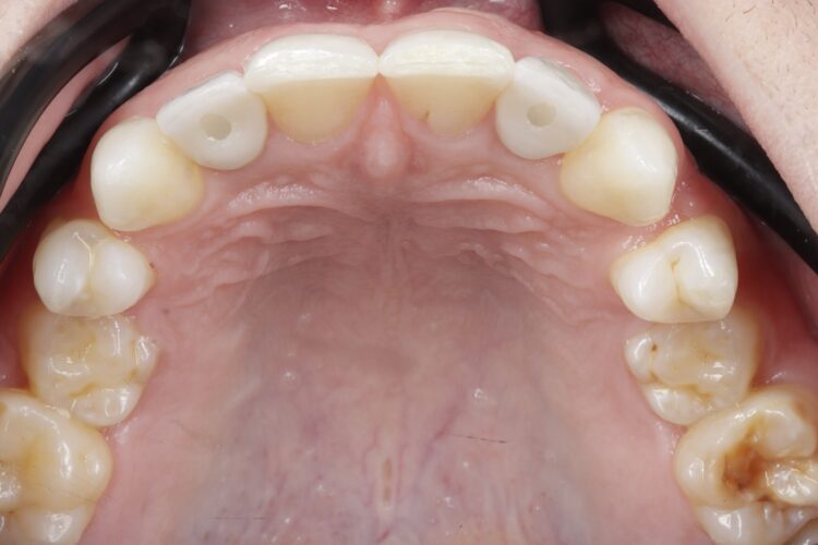 Figure 19: Final review occlusal