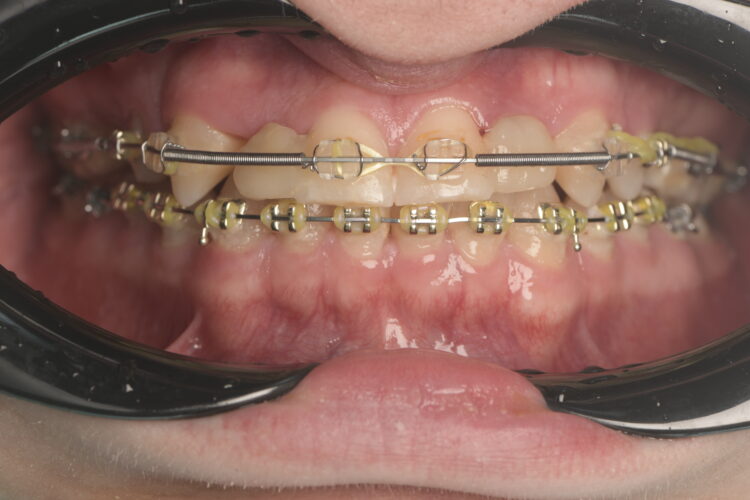 Figure 2: Mid-orthodontic correction