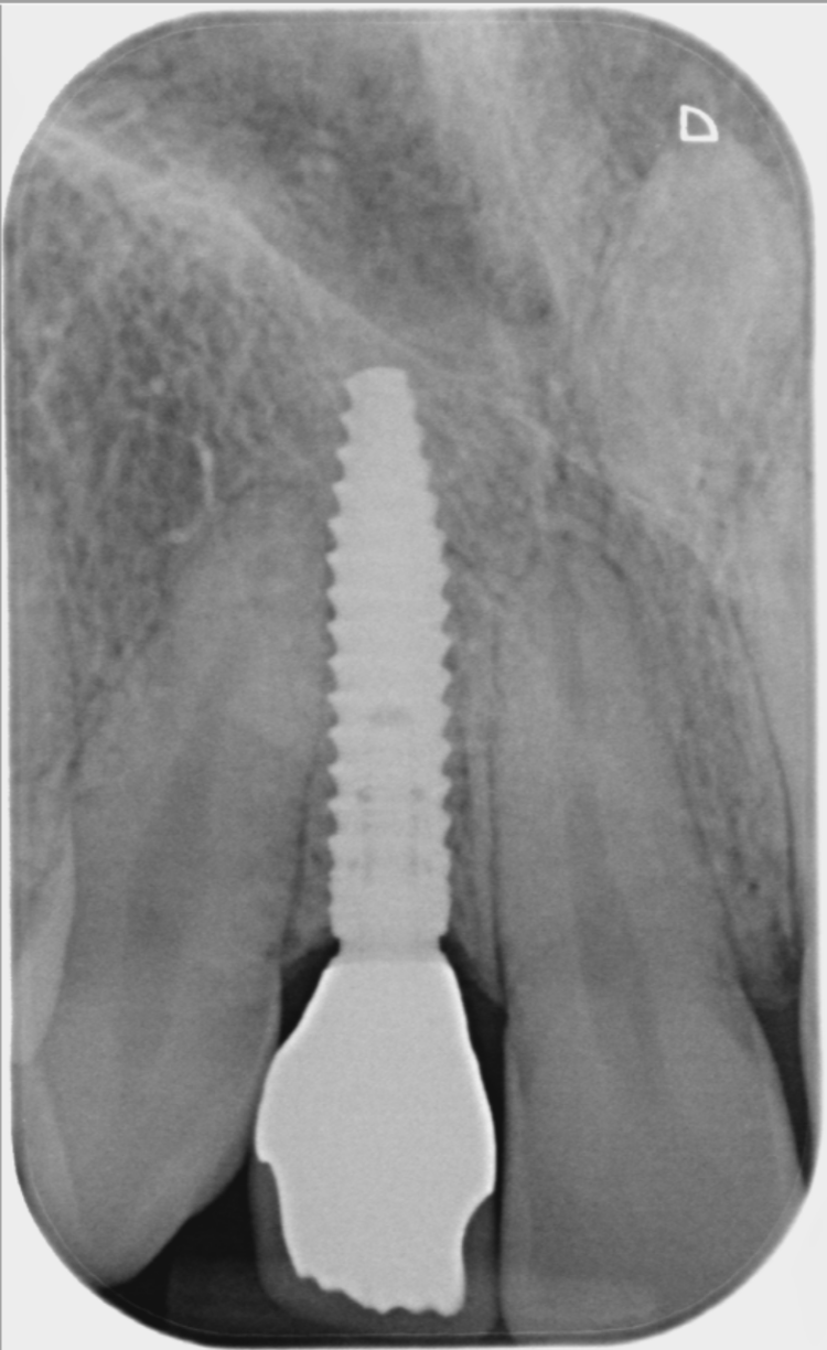 Figure 20: UL1 final x-ray
