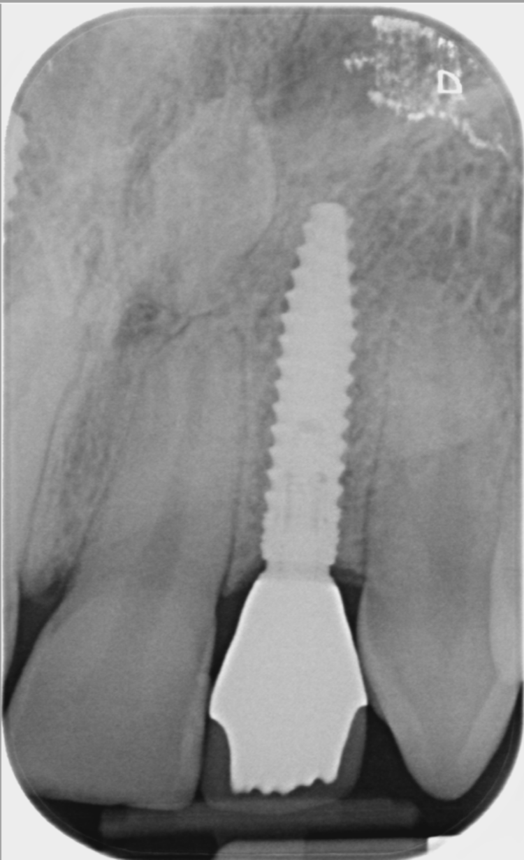 Figure 21: UL1 final x-ray