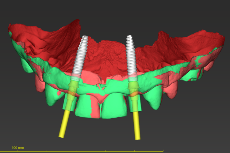 Figure 22: Overlay of final position of the implants with the treatment scan