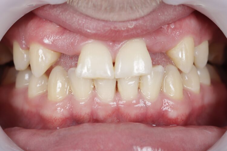 Figure 3: Post orthodontic, pre-treatment