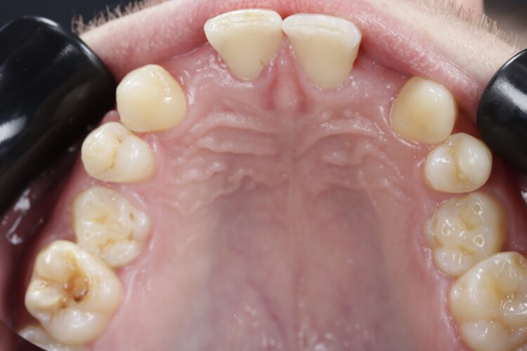 Figure 4: Post orthodontic pre-treatment