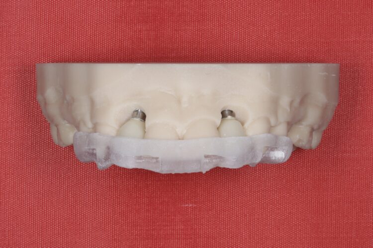 Figure 6: lab made provisional implant crowns on model