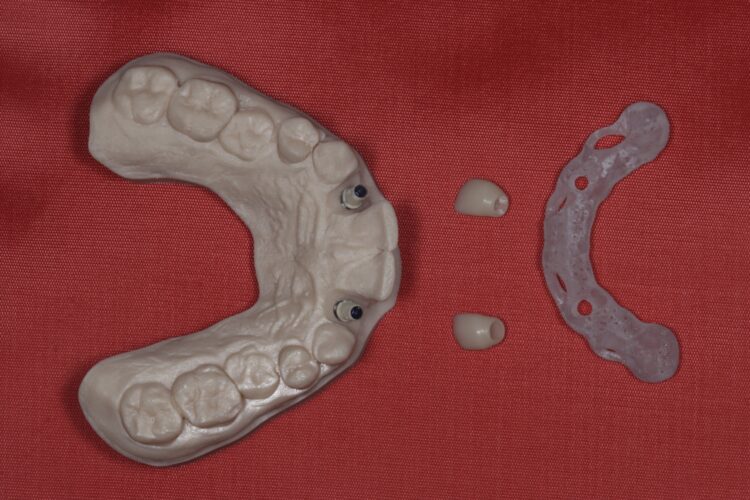 Figure 7: Lab made provisional implant crowns with jig
