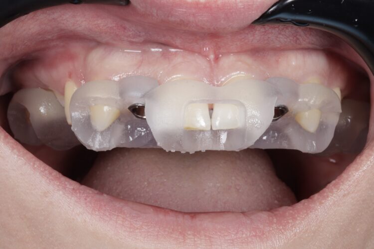 Figure 8: Surgical guide checking fit prior to implant surgery