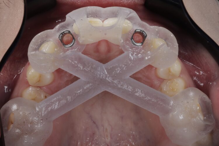 Figure 9: Surgical guide upper occlusal checking fit prior to implant surgery