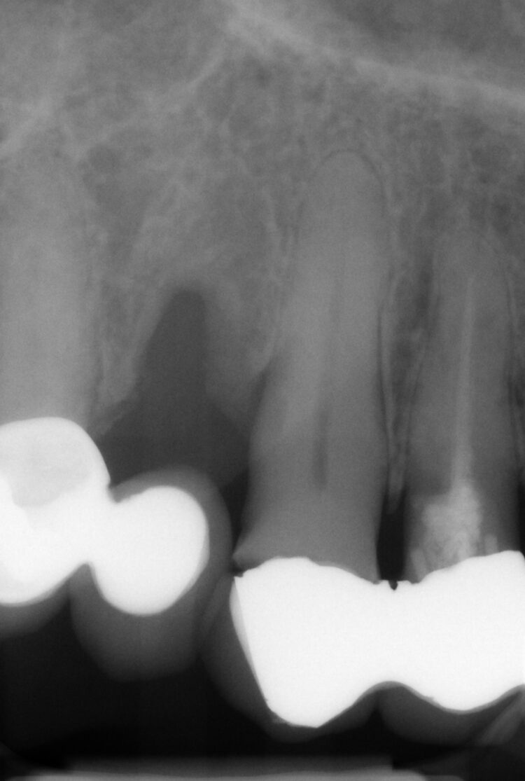 Tapered Pro Conical dr iqbal