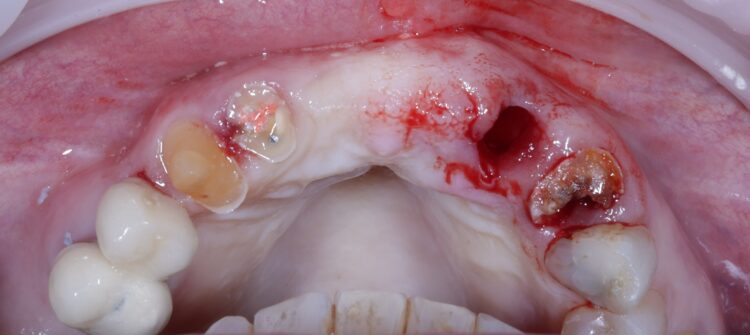 Tapered Pro Conical dr iqbal