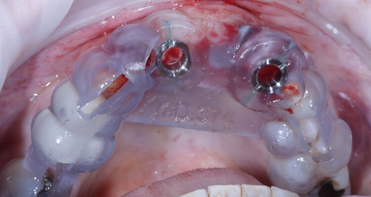 Tapered Pro Conical dr iqbal