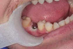 Delivering implant stability with no compromise