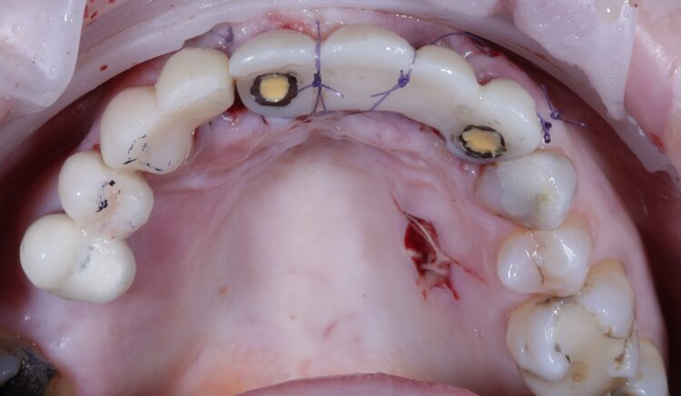 Tapered Pro Conical dr iqbal