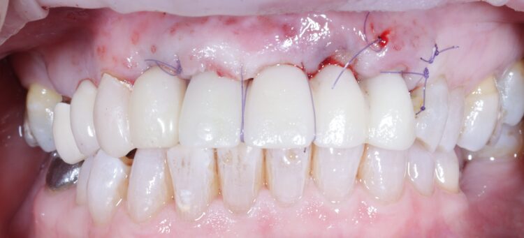 Tapered Pro Conical dr iqbal