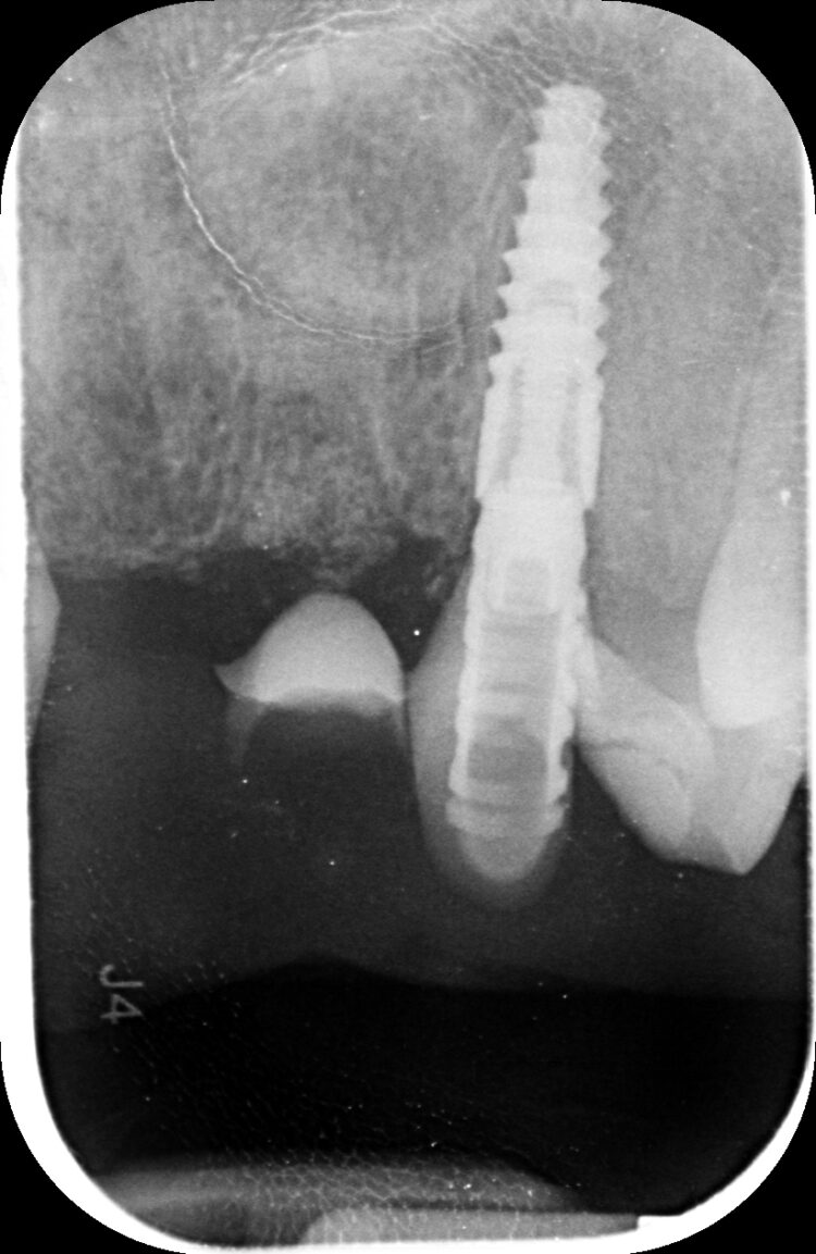 Tapered Pro Conical dr iqbal