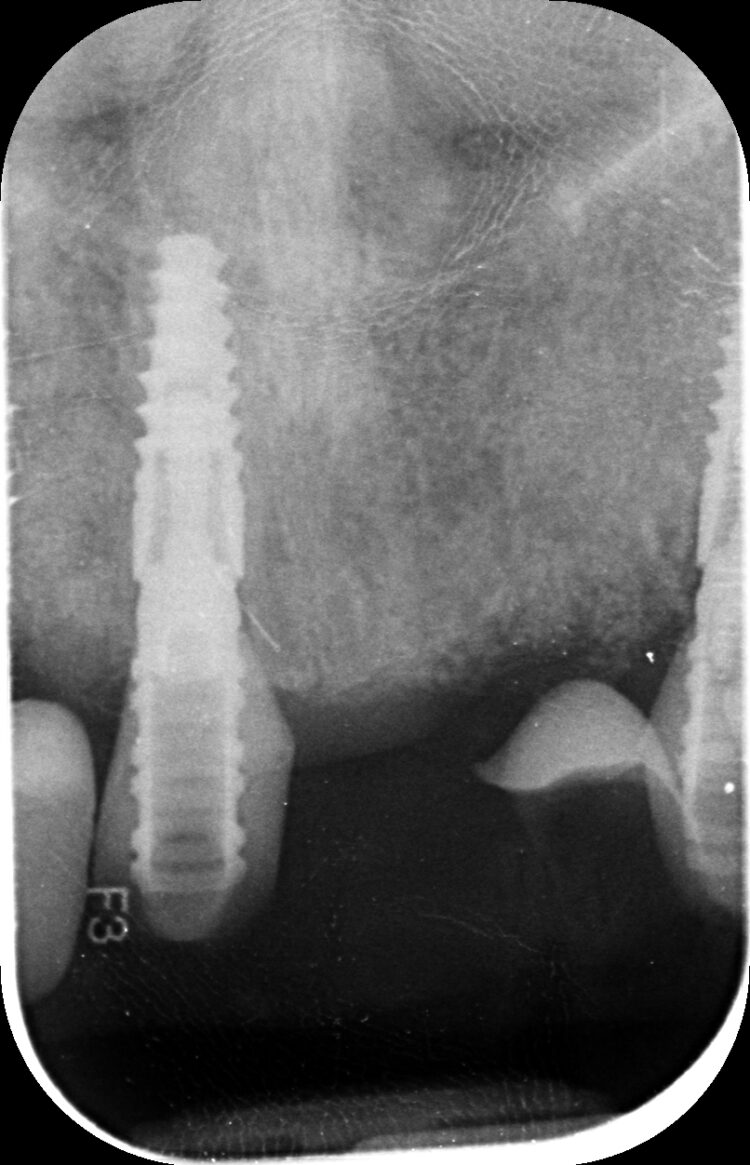 Tapered Pro Conical dr iqbal