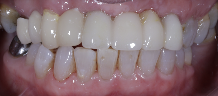 Tapered Pro Conical dr iqbal
