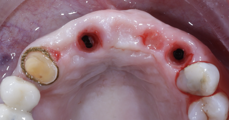 Tapered Pro Conical dr iqbal