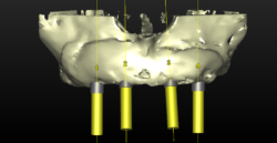 simplant implant planning grafting material
