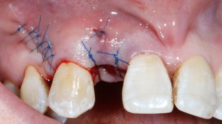Fig 10 - Flap closure with intentional open wound healing
