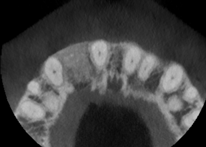 Fig 12a - Seven month review CBCT scan