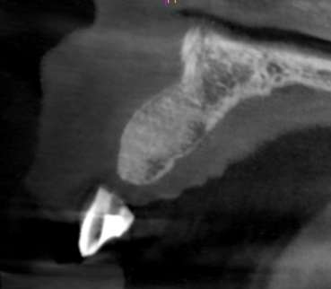 Fig 12b - Seven month review CBCT scan