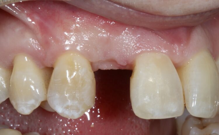 Fig 13 - Seven month review clinical assessment confirming thin soft tissues