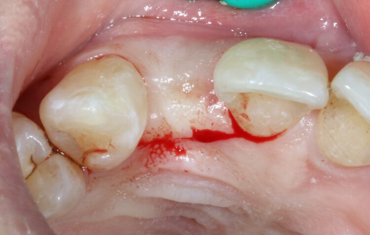 Fig 14 - Palatal crestal incision made