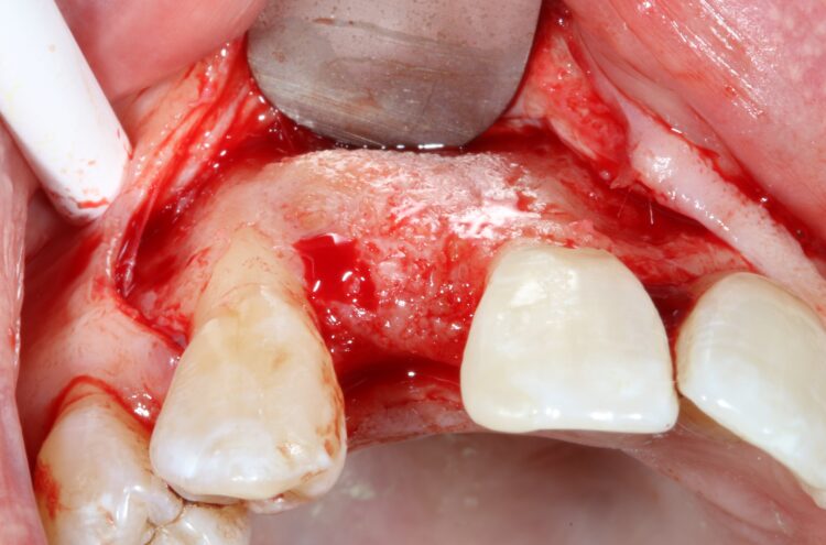 Fig 15 - Full thickness flap raised revealing good bone turnover