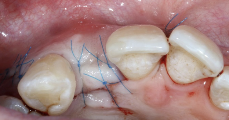 Fig 19- Flap sutured for complete closure
