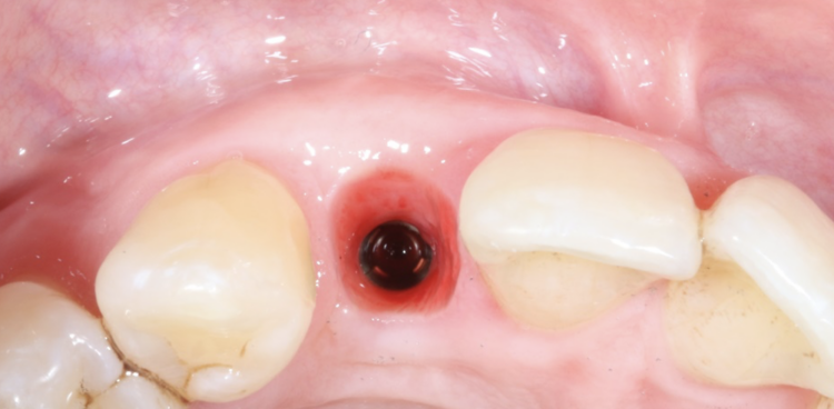 Fig 20 - Emergence profile development with a provisional crown