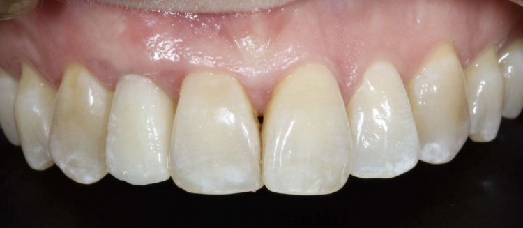 Figure 21: Final restoration at three year review