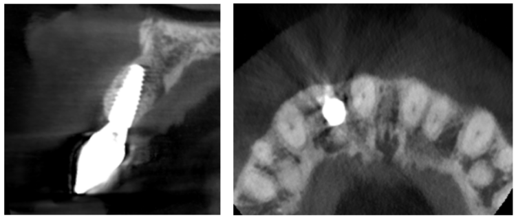 Fig 22 - CBCT scan at three year review