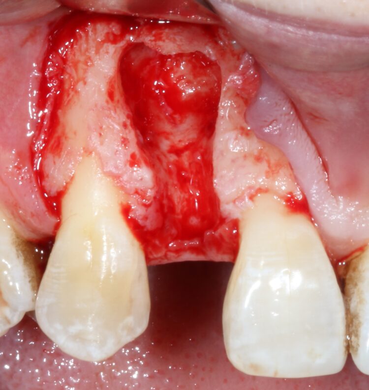 Fig 6a - Large full thickness flap raised